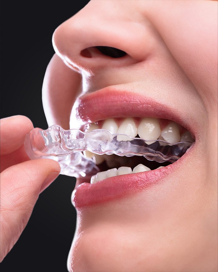 Aligner Tedavisi